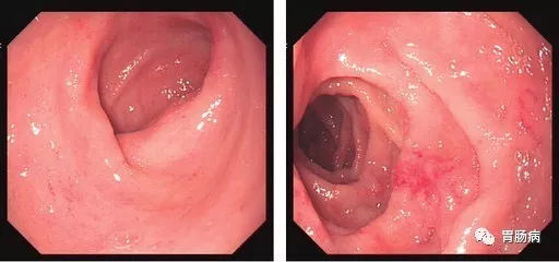 萎縮性胃炎不可怕，只要真正了解它